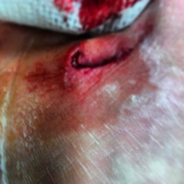 wound_zpsd4c3b254.jpg